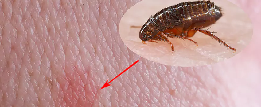 Flea Control for Humans Garden Grove, CA